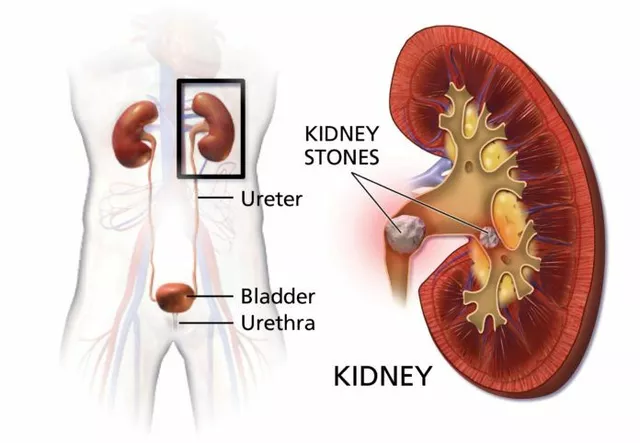 Biosoprolol and Kidney Stones: Is There a Connection?