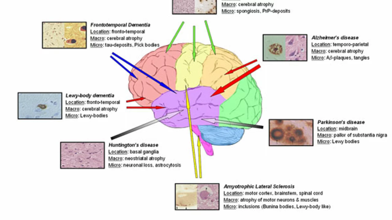 The Importance of Memantine in Neurodegenerative Disorders